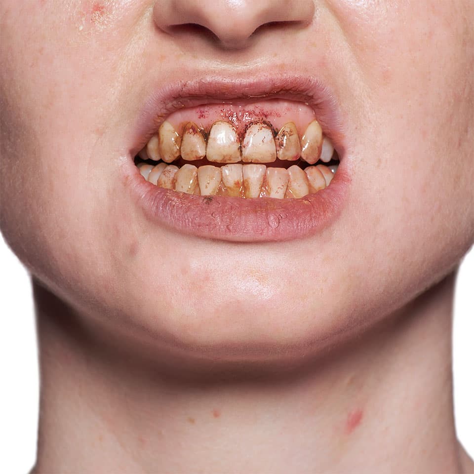 Tooth Enamel - Image 3